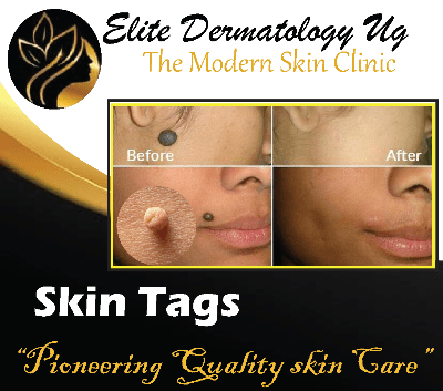 skin-tags-guide-elite-dermatology-ug-