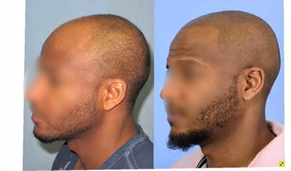a man with alopicea before and after restoring hairline with SMP treatment